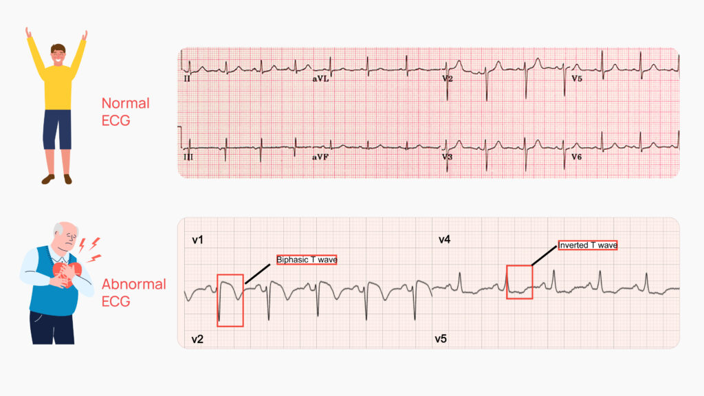 What does Normal ECG and Abnormal ECG mean?
