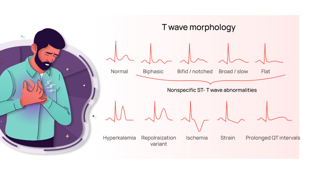 Understanding T Wave Abnormality: Symptoms, causes and treatment