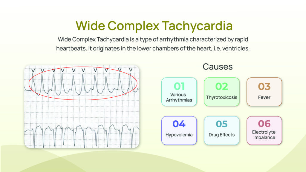 What Happens in Wide Complex Tachycardia?