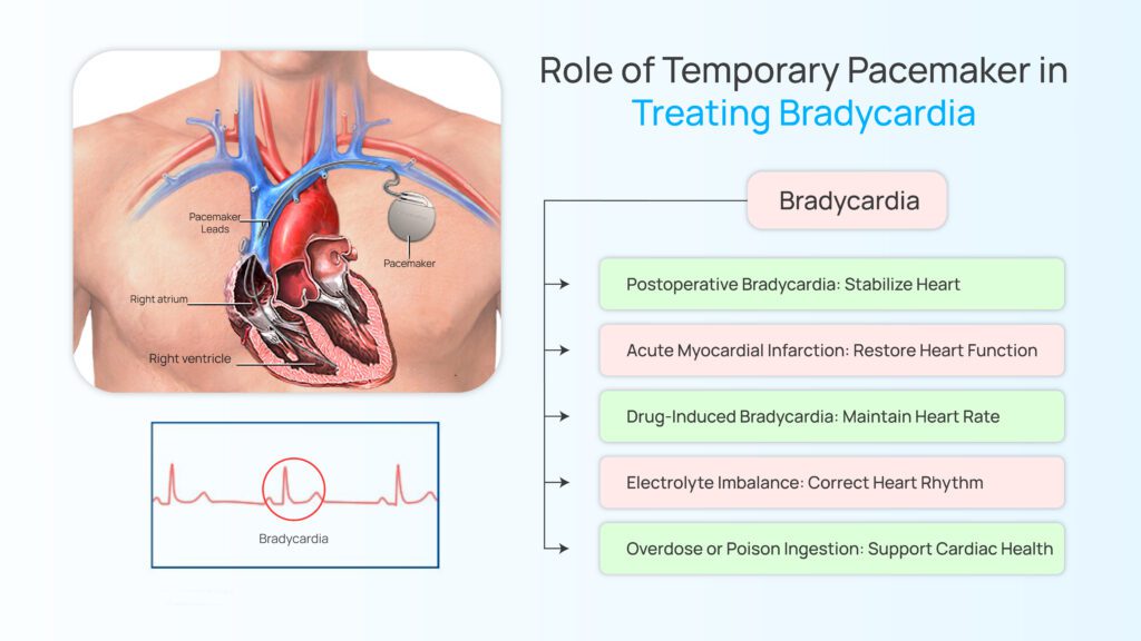 Role of Temporary Pacemaker in Treating Bradycardia