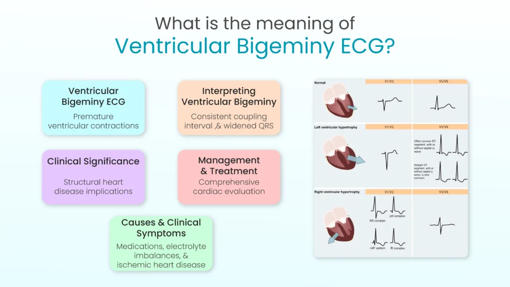 What is the meaning of Ventricular Bigeminy ECG?
