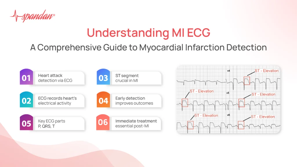 Understanding MI ECG: A Comprehensive Guide to Myocardial Infarction Detection