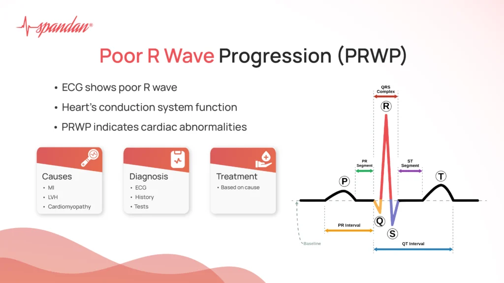 Poor R Wave Progression (PRWP)