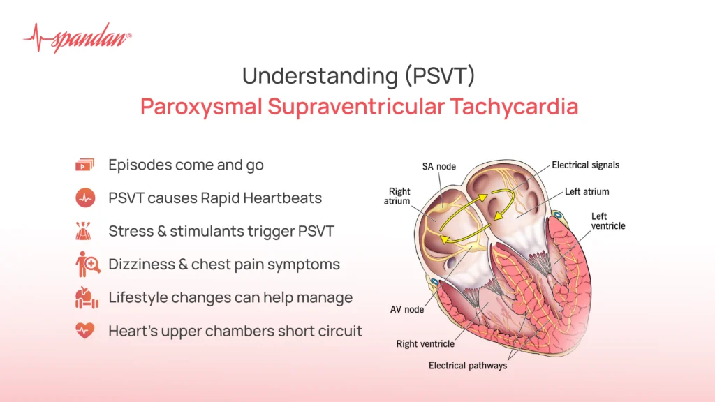 Understanding Paroxysmal Supraventricular Tachycardia (PSVT)