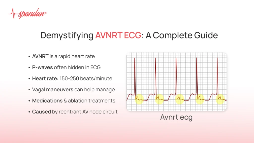 Demystifying AVNRT ECG: A Complete Guide
