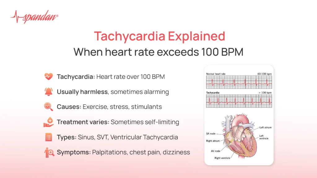 Tachycardia Explained: When heart rate exceeds 100 BPM