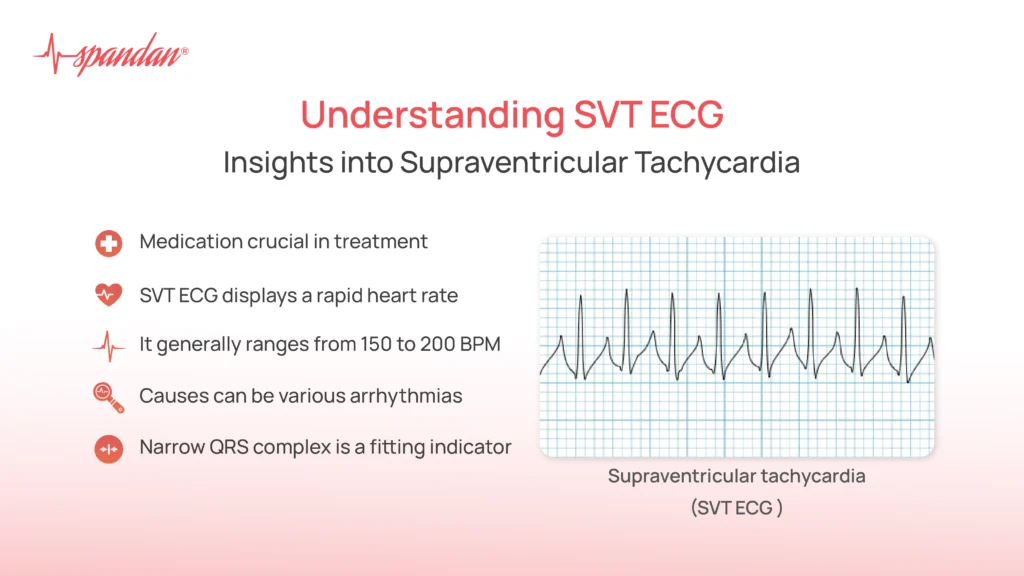 Understanding SVT ECG: Insights into Supraventricular Tachycardia