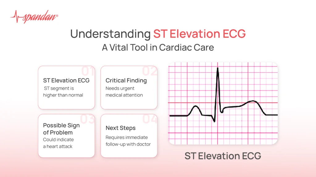 Understanding ST Elevation ECG: A Vital Tool in Cardiac Care