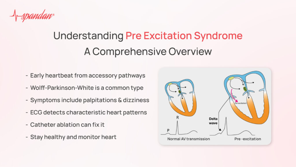 Understanding Pre Excitation Syndrome: A Comprehensive Overview