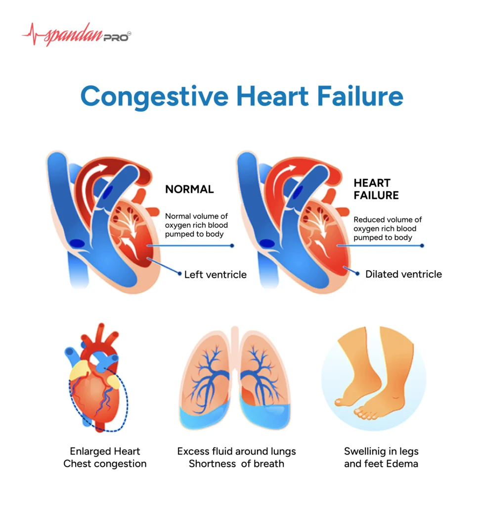 congestive heart failure