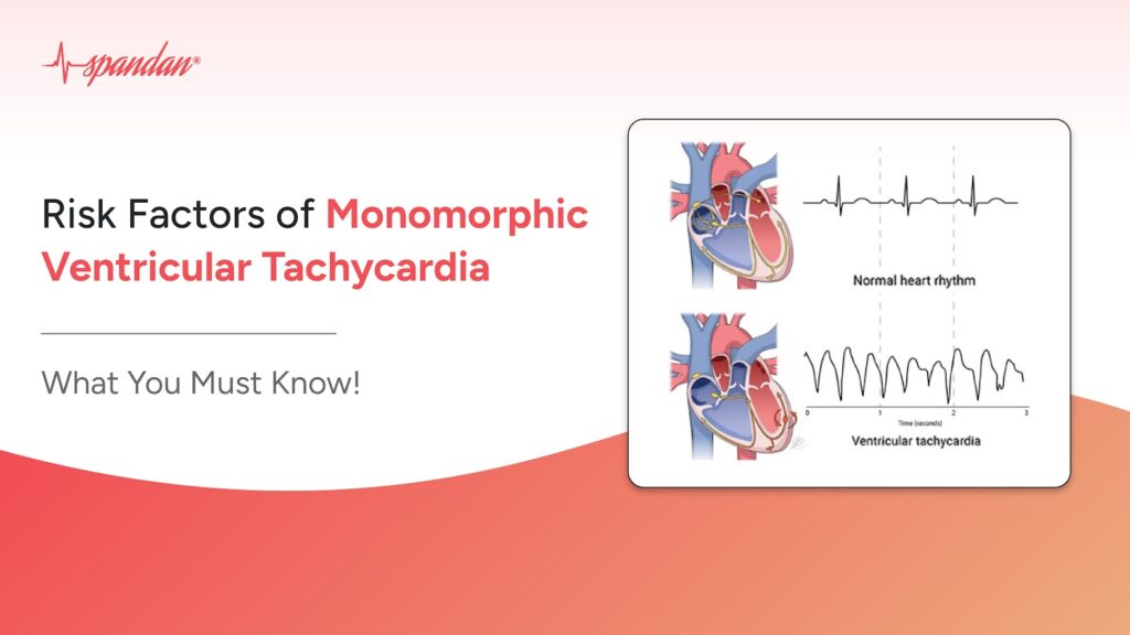 Risk Factors of Monomorphic Ventricular Tachycardia: What You Must Know